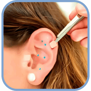 Auriculoterapia